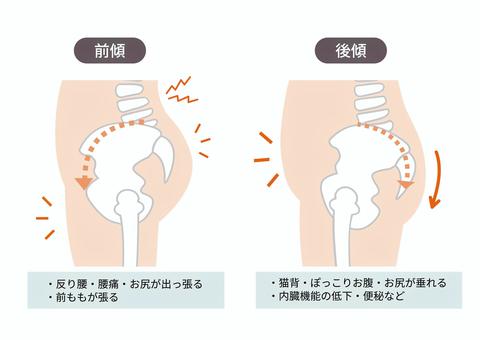 骨盤の傾き。前傾と後傾。