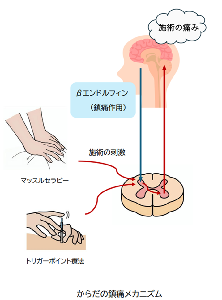 手技やトリガーポイント鍼灸による鎮痛作用