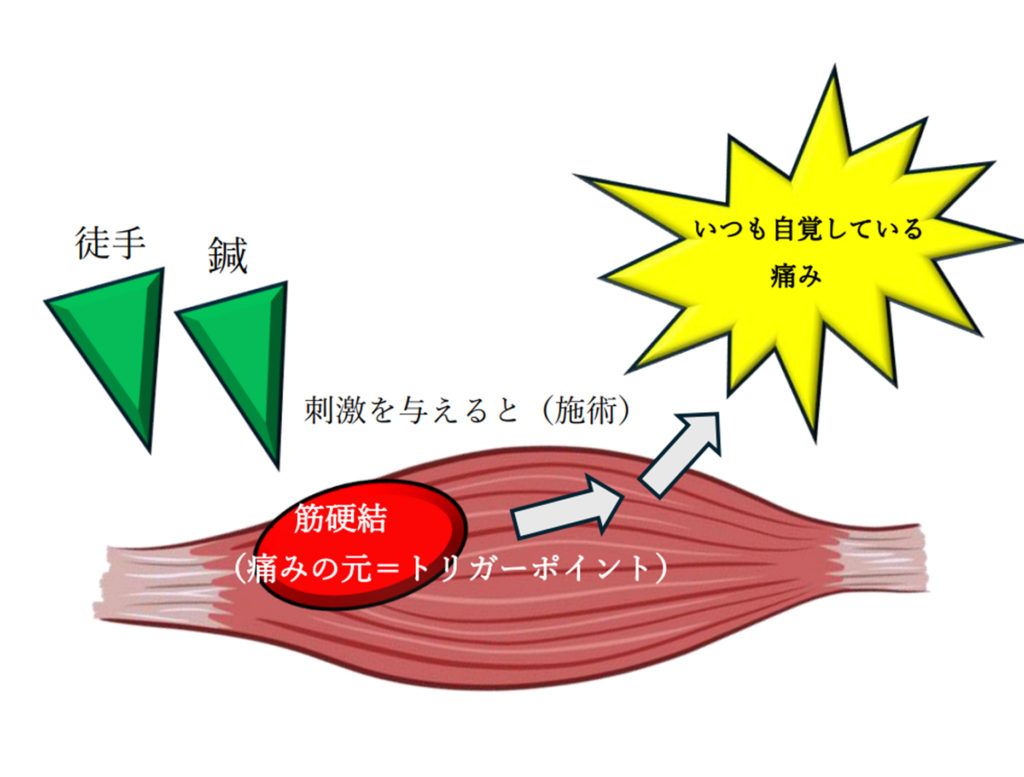 トリガーポイント