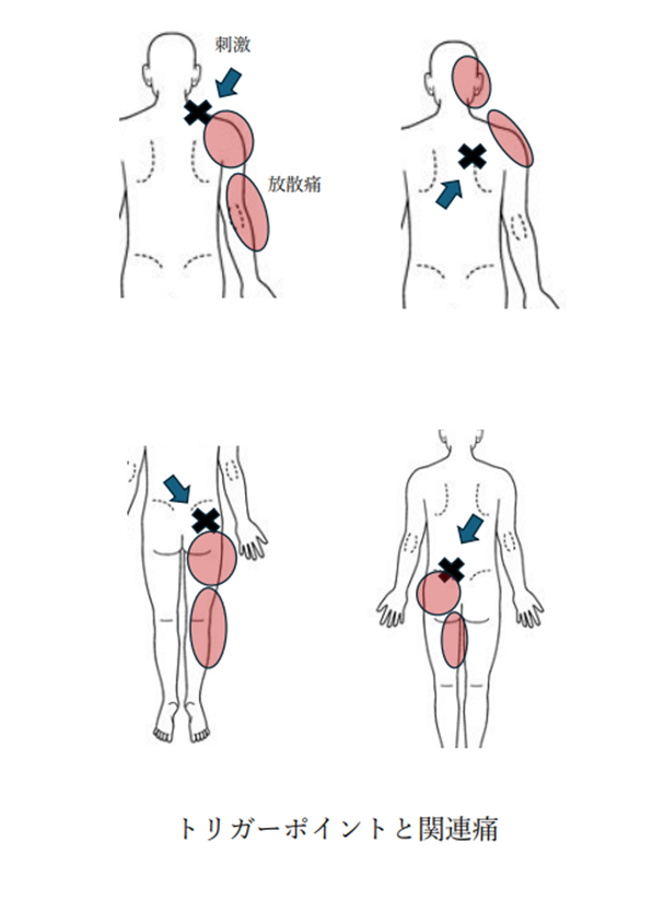 トリガーポイントと関連痛