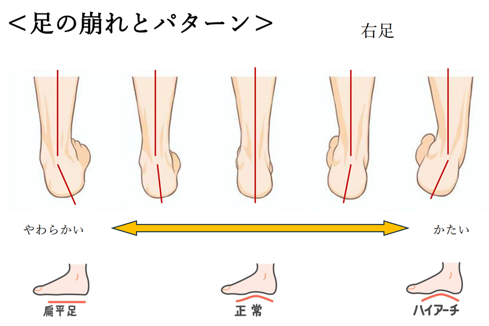 回内足、回外足