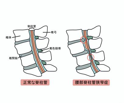 脊柱管狭窄症